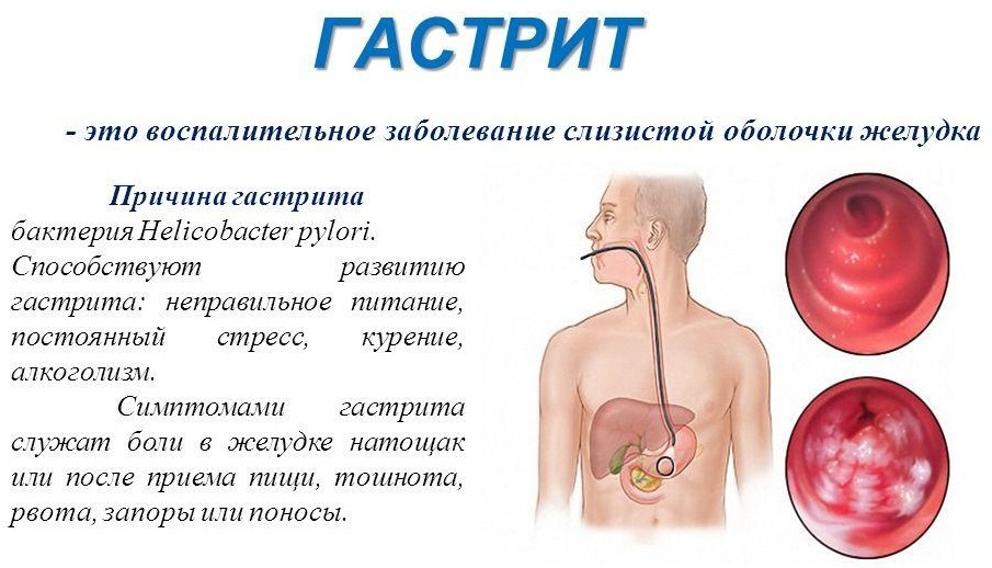 Воспаление слизистой желудка — прямая угроза здоровью всего организма