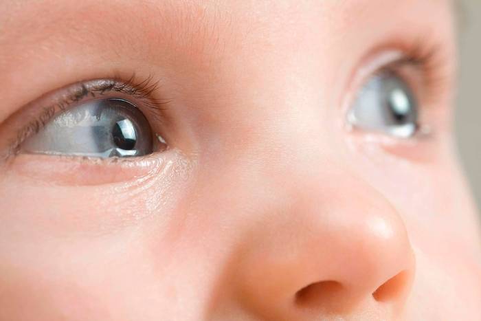 Гноится глаз у новорожденного. что делать? | nutrilak