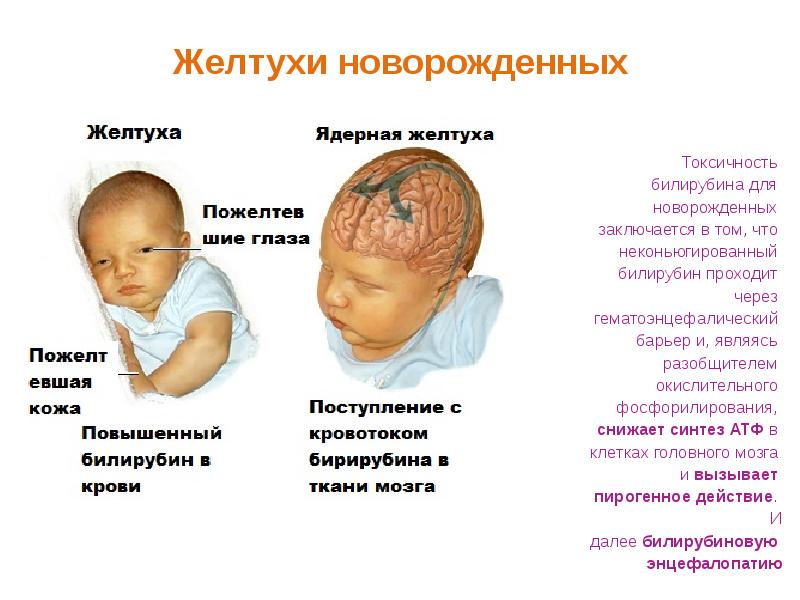 Как предотвратить появление желтухи у новорожденных