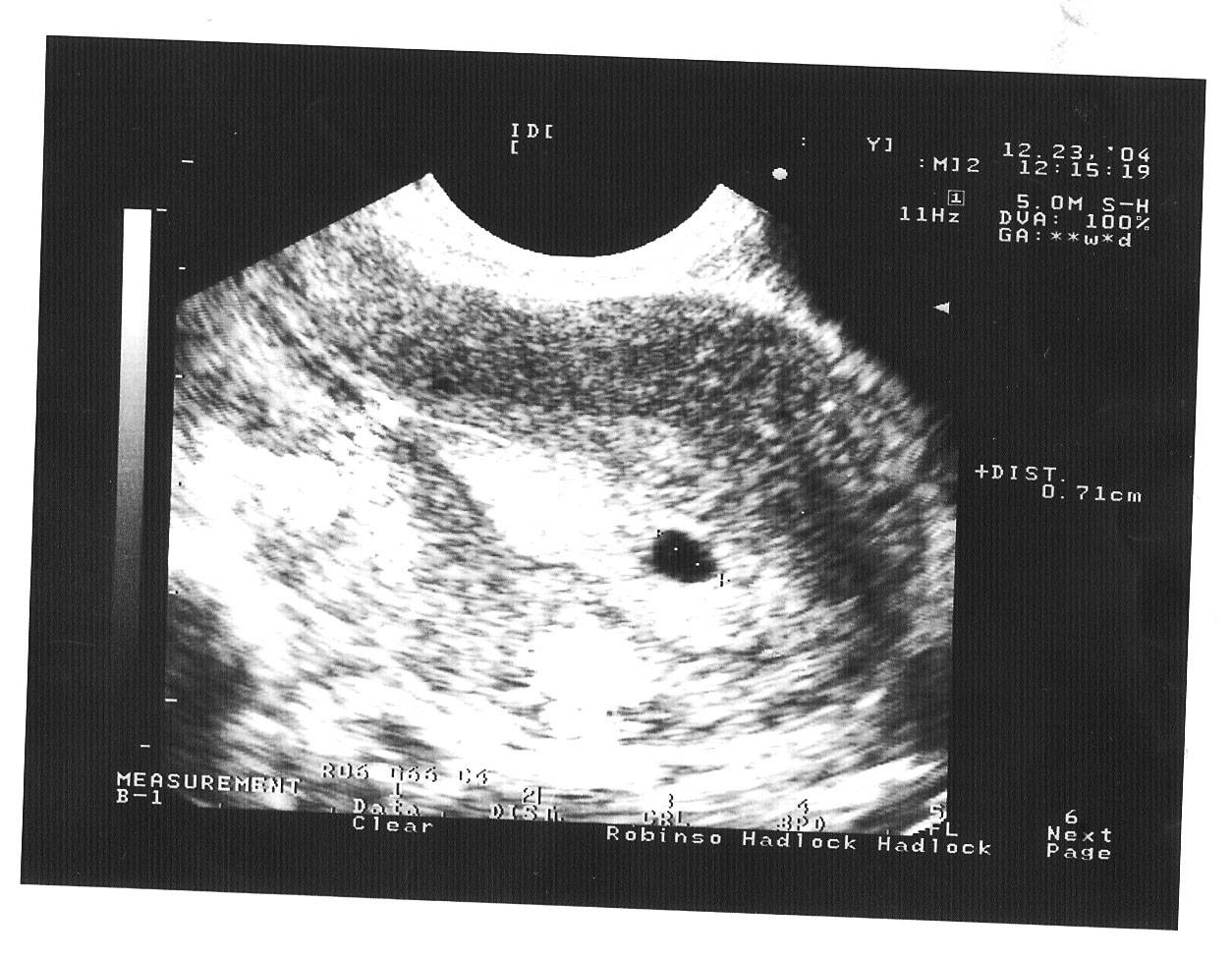 5 недель беременности после эко - клиника «к+31»