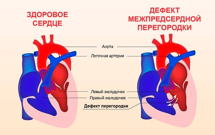 Если у новорождённого открытое овальное окно в сердце — разъясняет детский кардиолог