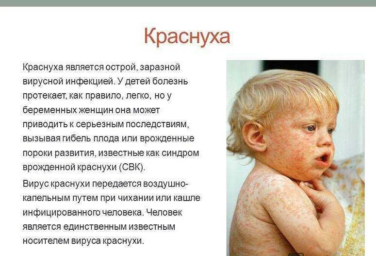Розеола у детей: симптомы и лечение, фото сыпи, профилактика трехдневной лихорадки