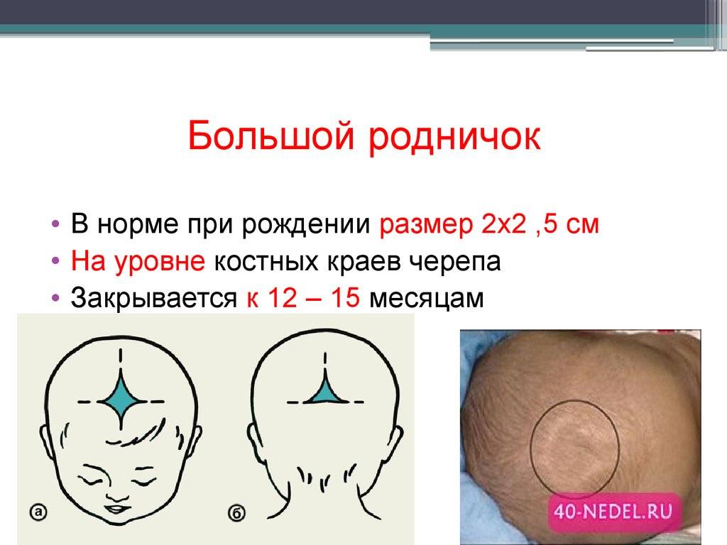 Главное о родничках у новорождённого и ответы неонатолога на часто задаваемые вопросы родителей