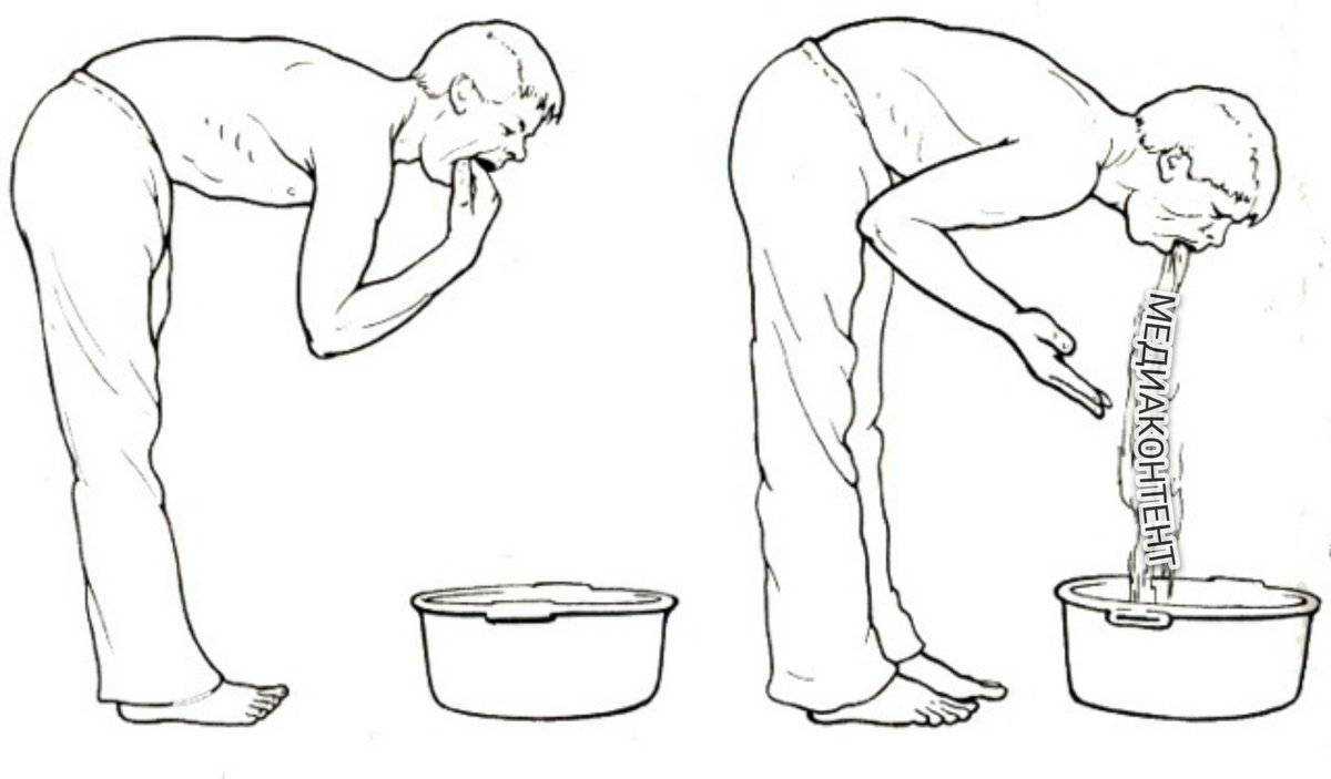Сильно тошнит но не рвет. Промывание желудка. Рвота промывание желудка. Беззондовое промывание желудка. Промывание желудка при отравлении.