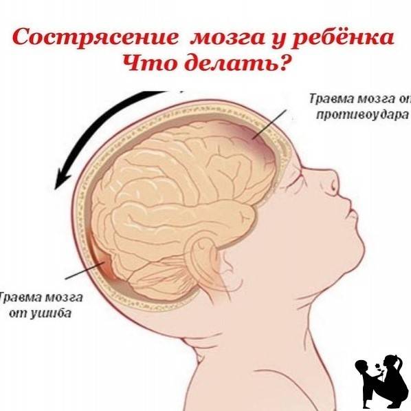 Сотрясение мозга - медицинский центр «эхинацея»