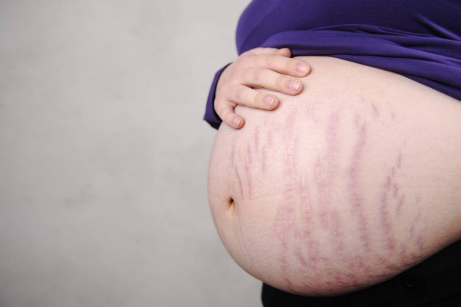 Растяжки во время беременности: причины появления, профилактика и лечение   | материнство - беременность, роды, питание, воспитание