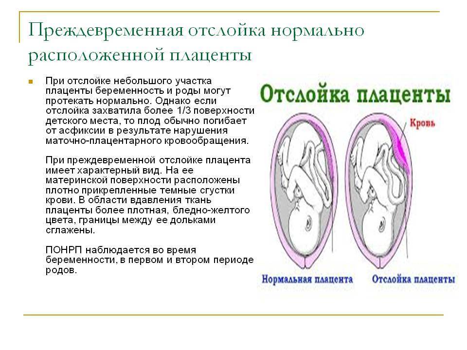 Отслойка плаценты - симптомы, диагностика, лечение