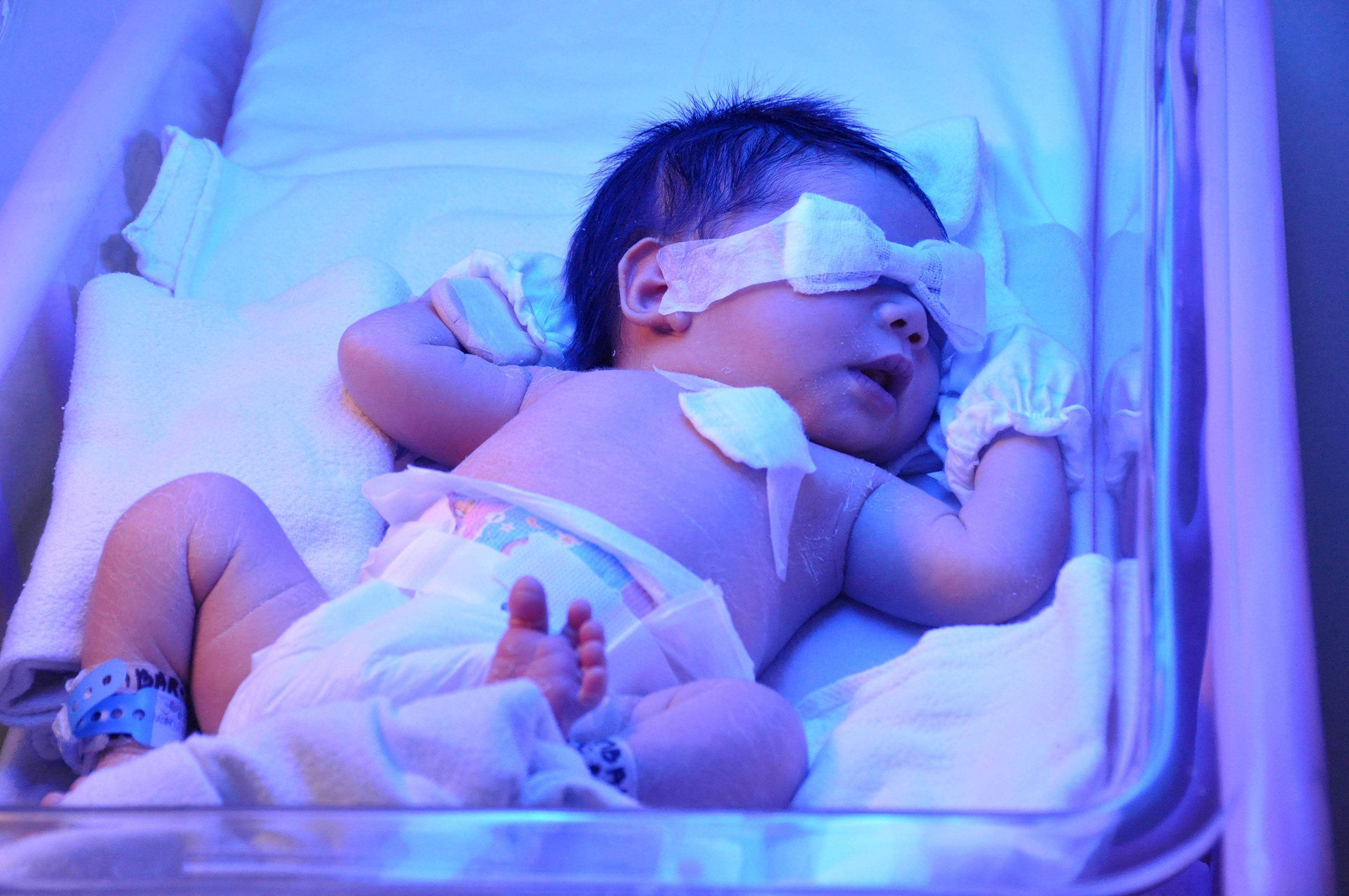 Желтушка у новорожденных фототерапия. Гипербилирубинемия желтуха новорожденных. Новорожденных под лампой отжельухи. Лампа для новорожденных от желтушки в роддоме. Желтушка новорожденных сколько дней