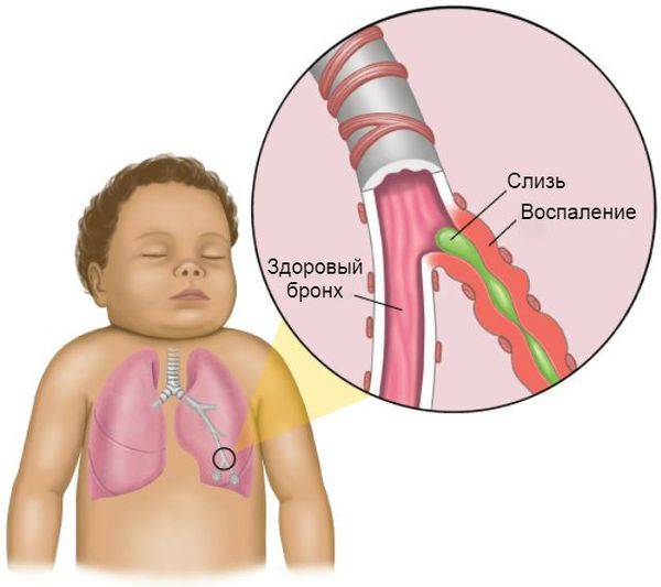 Лечим бронхит у детей