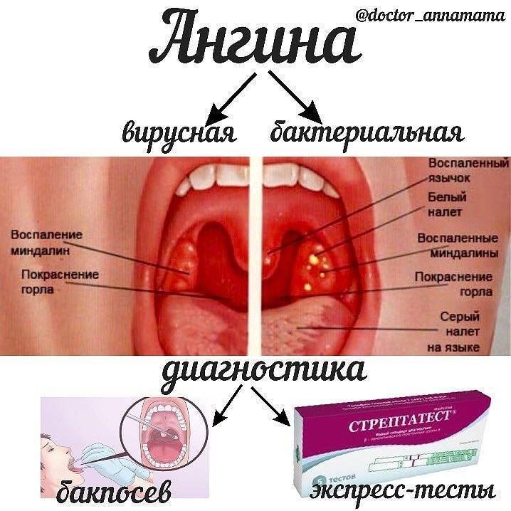 Противовирусные препараты при ангине для детей