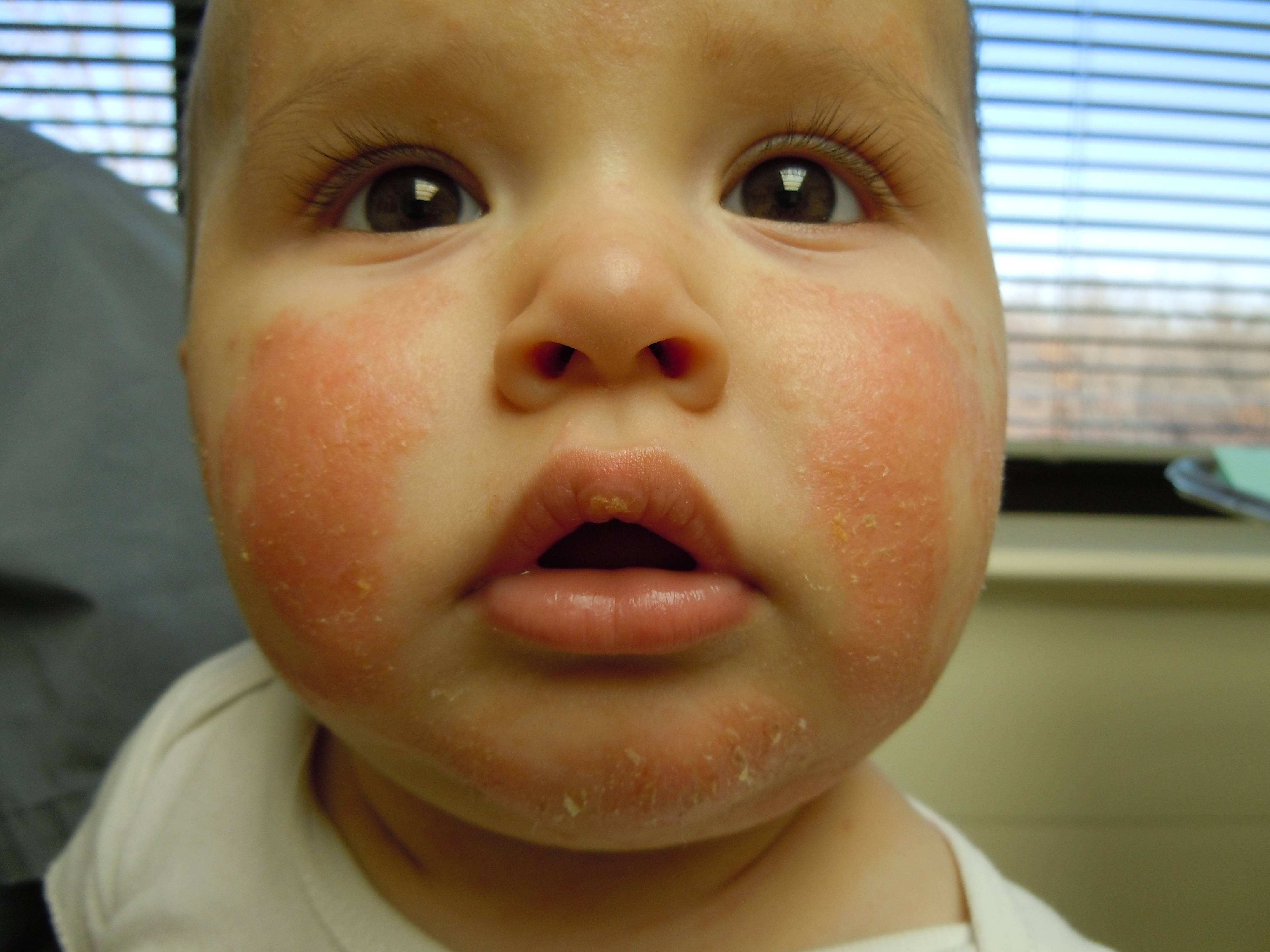 Атопич. Экссудативная форма атопического дерматита. Гнейс атопический дерматит. Атопический дерматит у детей атопик.
