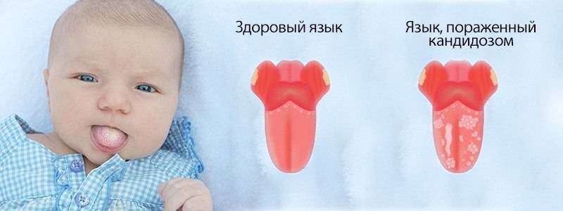 Молочница во рту: причины и лечение - стоматология блеск новосибирск