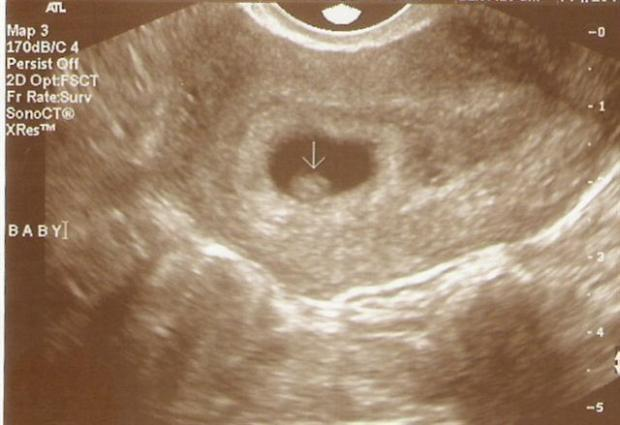 3 неделя беременности: что происходит, фото плода, признаки, симптомы, узи