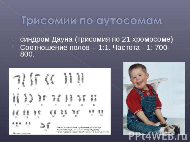 Синдром дауна (трисомия по 21-й паре хромосом)
