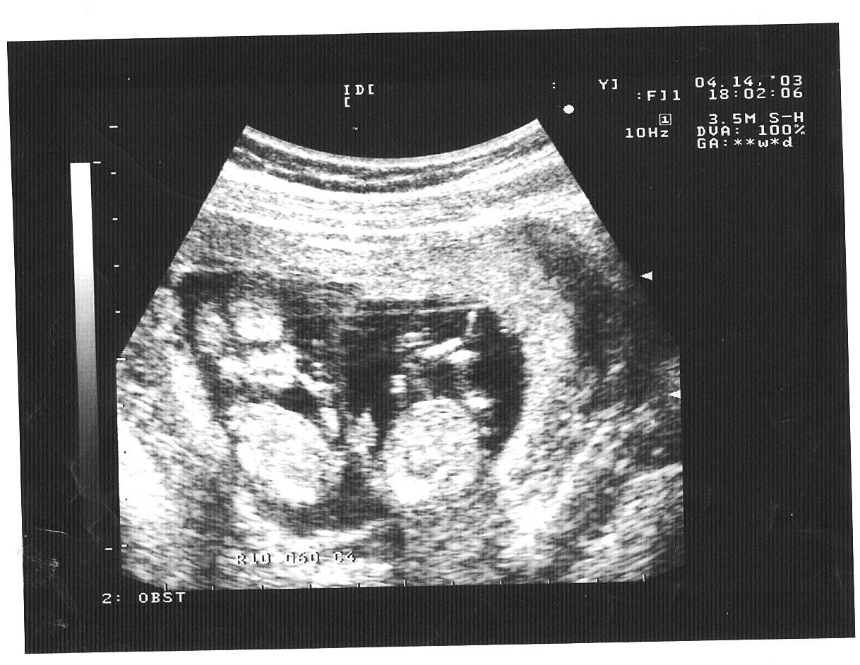 Двойня 26 недель. УЗИ 11 недель беременности двойня. УЗИ 10 недель беременности двойня. Фото УЗИ двойни на 10 неделе беременности. УЗИ двойняшек на 20 неделе беременности.