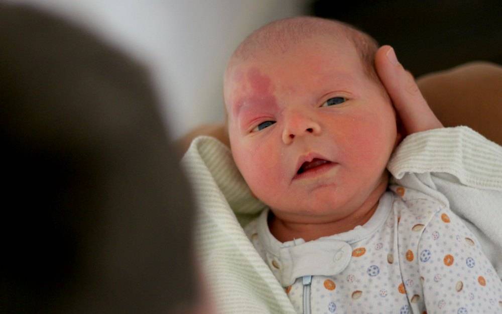 Гемангиома у новорожденных – причины возникновения