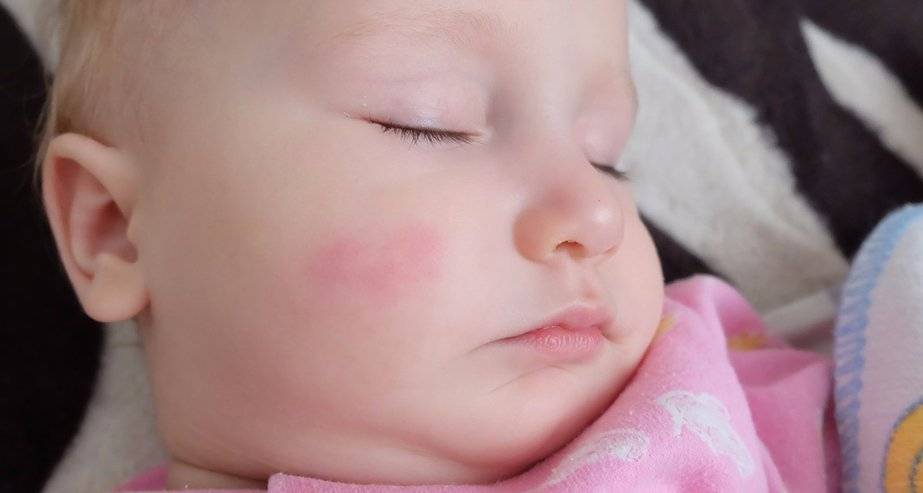 Аллергия у грудных детей: причины, симптомы и методы лечения