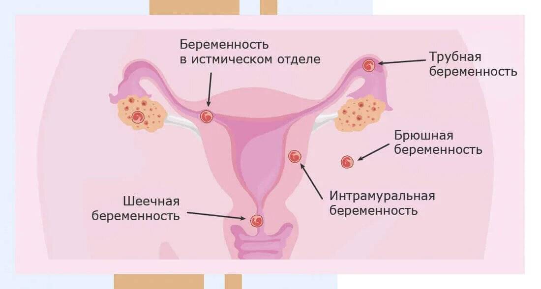 Внематочная беременность