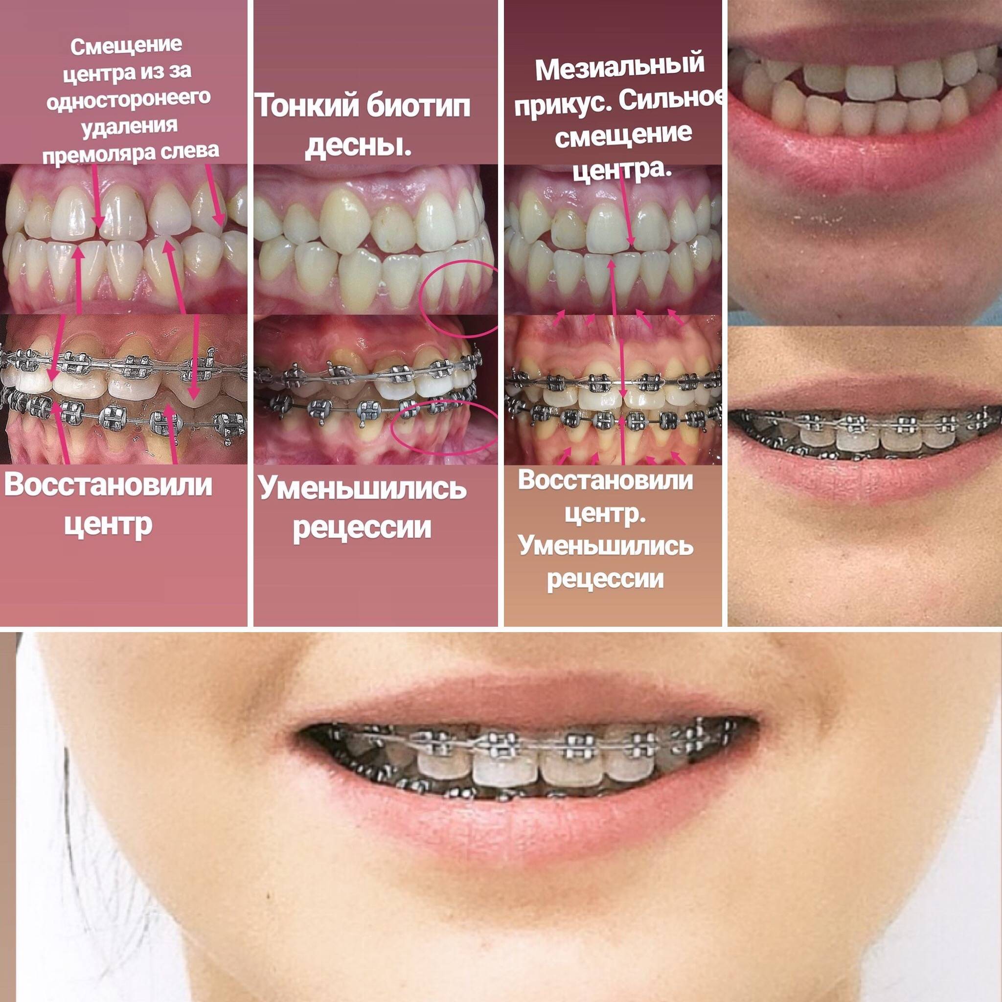 Отзывы после брекетов. Брекеты. Эстетические брекеты.