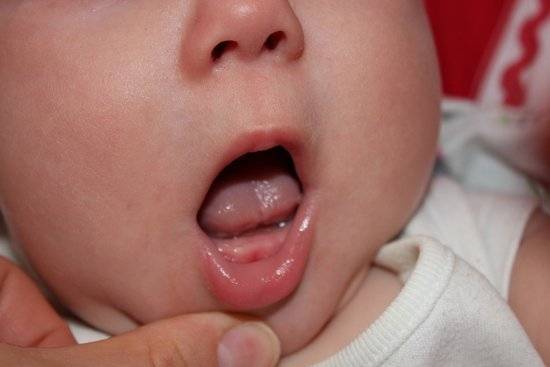 Молочница во рту у детей (+фото): симтомы и лечение – напоправку – напоправку