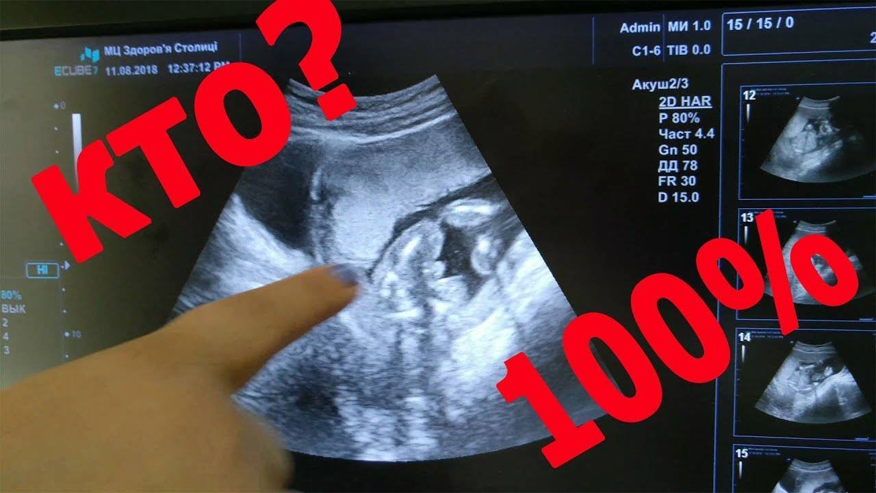 Узи 15 недель беременности пол ребенка фото