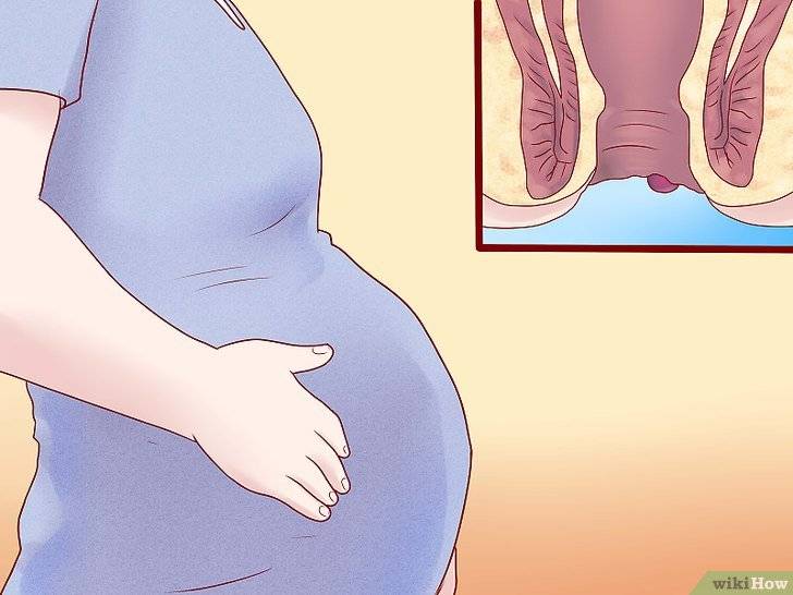 Геморрой при беременности - современные подходы к лечению