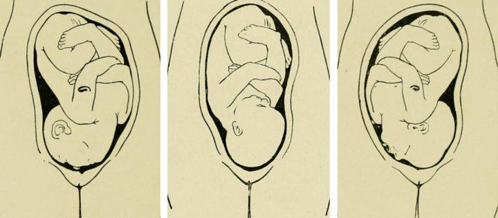 Когда переворачивается ребенок вниз головой перед родами: упражнения для беременной чтобы малыш перевернулся