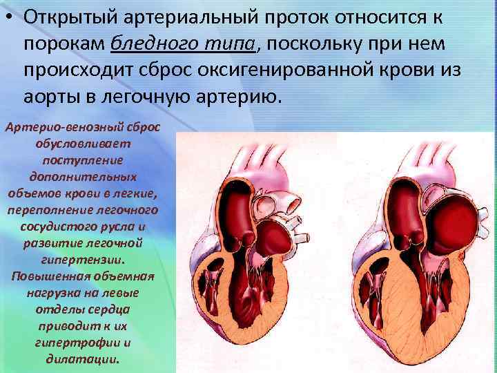 Если у новорождённого открытое овальное окно в сердце — разъясняет детский кардиолог