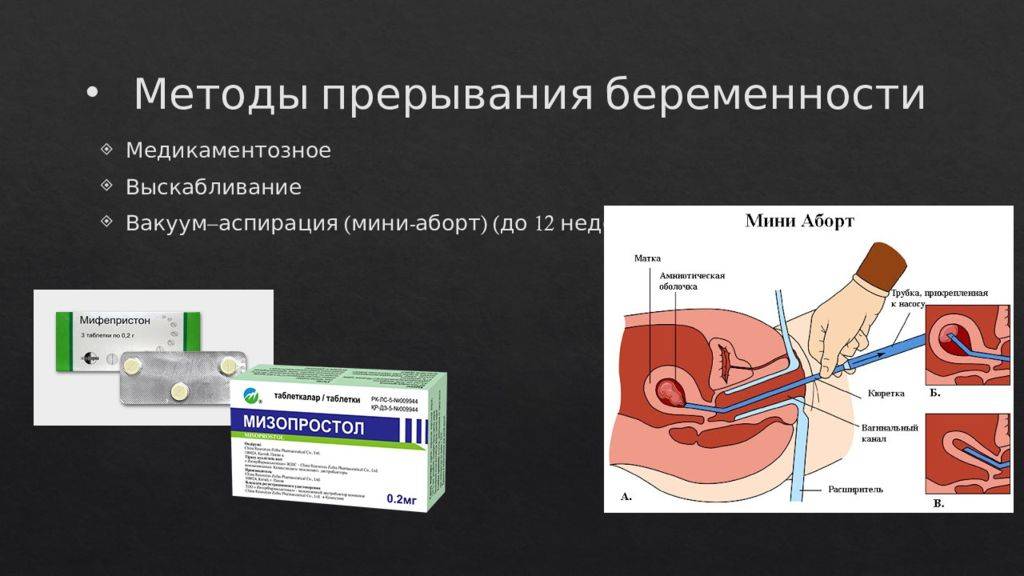 Антибиотики после выскабливания. Методы прерывания беременности. Мини-аборт (вакуум-аспирация). Хирургические методы аборта. Вакуум аспирация методика.