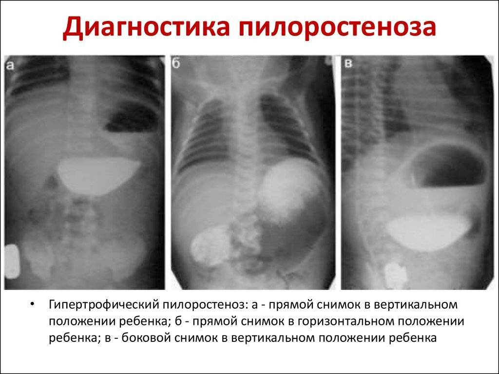 Врожденный пилоростеноз презентация