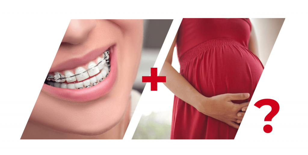 Исправление прикуса во время беременности на брекетах: что происходит с зубами во время вынашивания ребенка, что рекомендуют ортодонты
