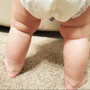 Что делать, если у младенца не симметричны складки на ножках — блог медицинского центра он клиник