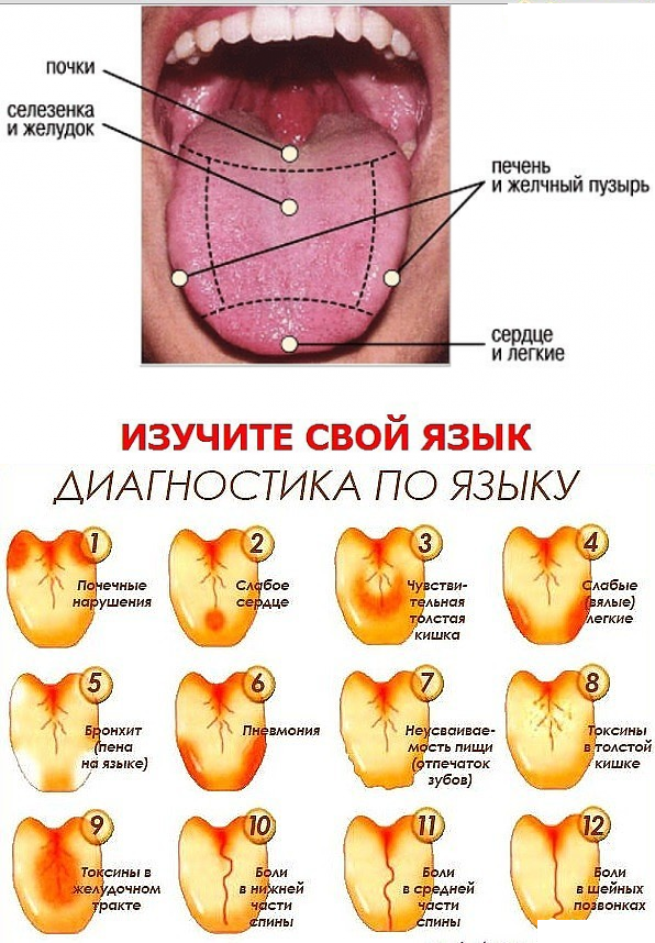 Герпесная ангина (лечение, симптомы), как лечится герпетическая ангина