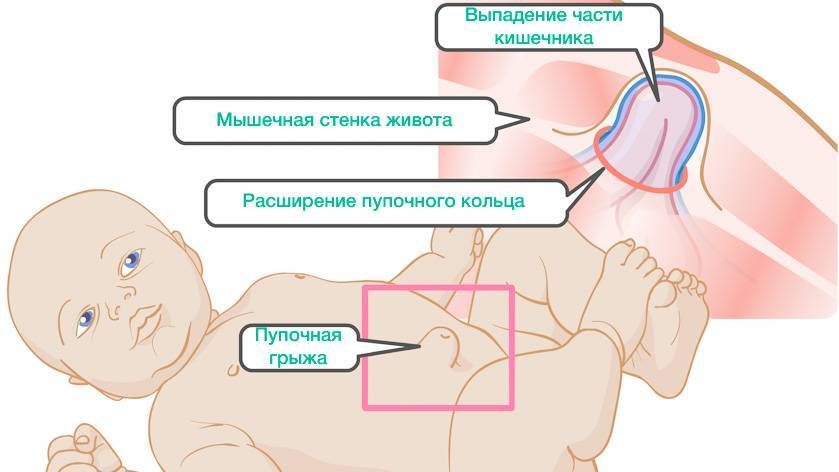 Как определить есть ли грыжа у новорожденных фото симптомы