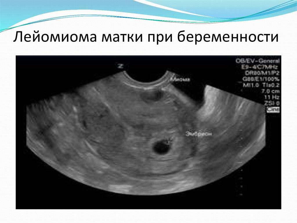 Миома матки и беременность: симптомы, признаки, как лечить %sep% +мама