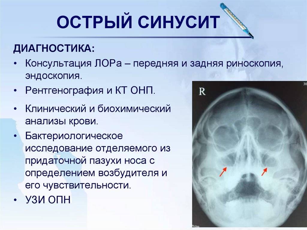 Гайморит - клиника «к+31»