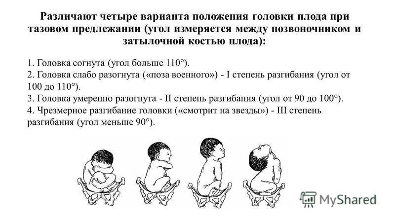 Лекция № 10. роды при тазовых предлежаниях плода