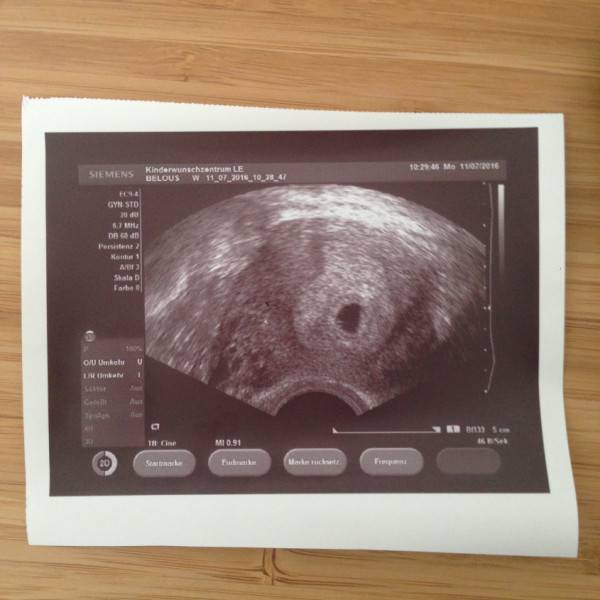 Узи при беременности — сроки проведения и особенности процедуры • центр гинекологии в санкт-петербурге