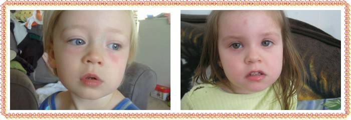 Мешки под глазами у ребенка: причины и лечение - здоровое око | za-rozhdenie.ru