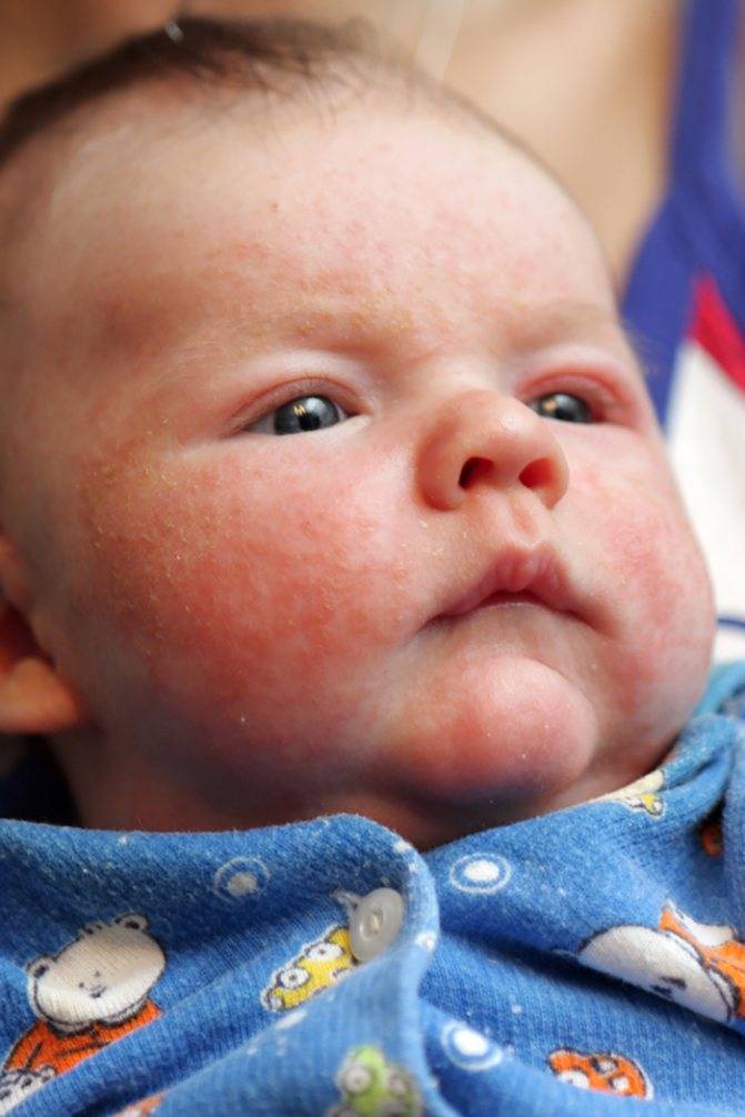 Цветение у новорожденных: фото на лице, признаки и лечение