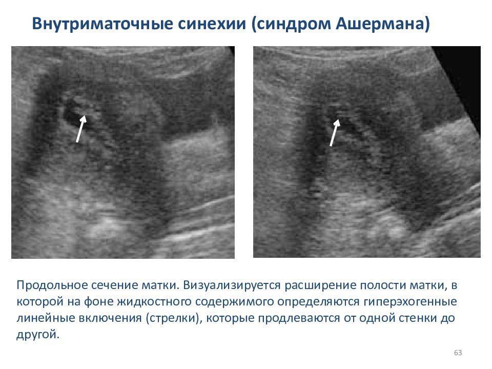 При спайках можно забеременеть. Внутриматочные синехии. Внутриматочные спайки на УЗИ.