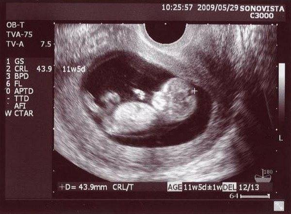 10 недель беременности шевеления. 11 Недель беременности фото плода на УЗИ. Фото плода на 11 неделе беременности фото УЗИ. Как выглядит ребенок на УЗИ В 11 недель. Эмбрион по УЗИ 11 недель.