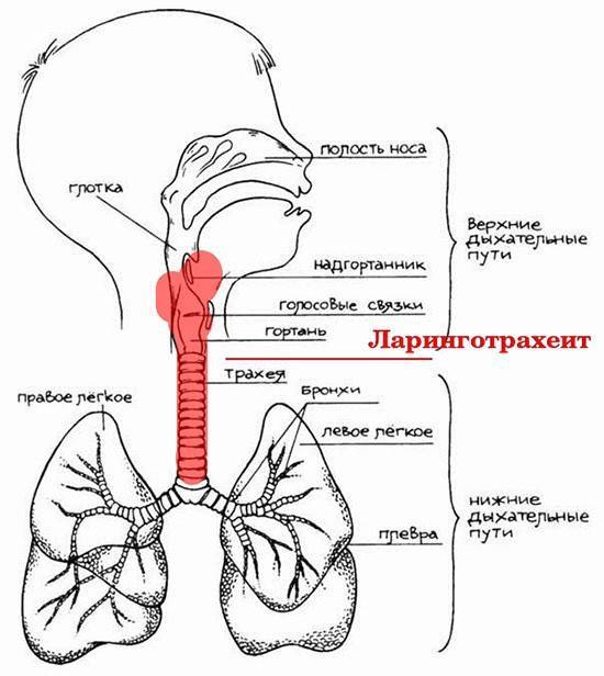 Клинический трахеит. Острый стенозирующий ларинготрахеит патогенез. Острый стенозирующий ларинготрахеит этиология. Острый обструктивный ларингит патогенез. Стенозирующий ларинготрахеит ложный круп что это.