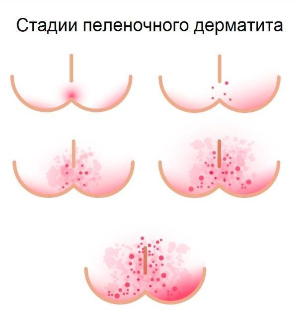 Что делать с опрелостью и сыпью у малыша под подгузником