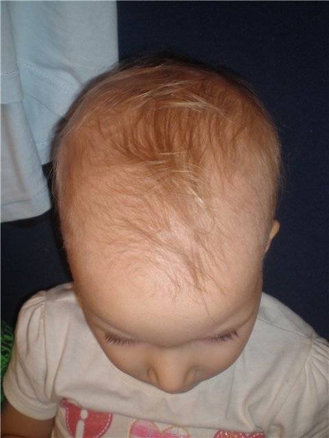 У ребенка плохо растут волосы, выпадают: причины, витамины (комаровский)