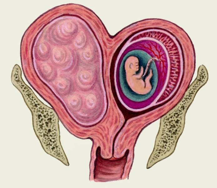 Беременность и миома матки