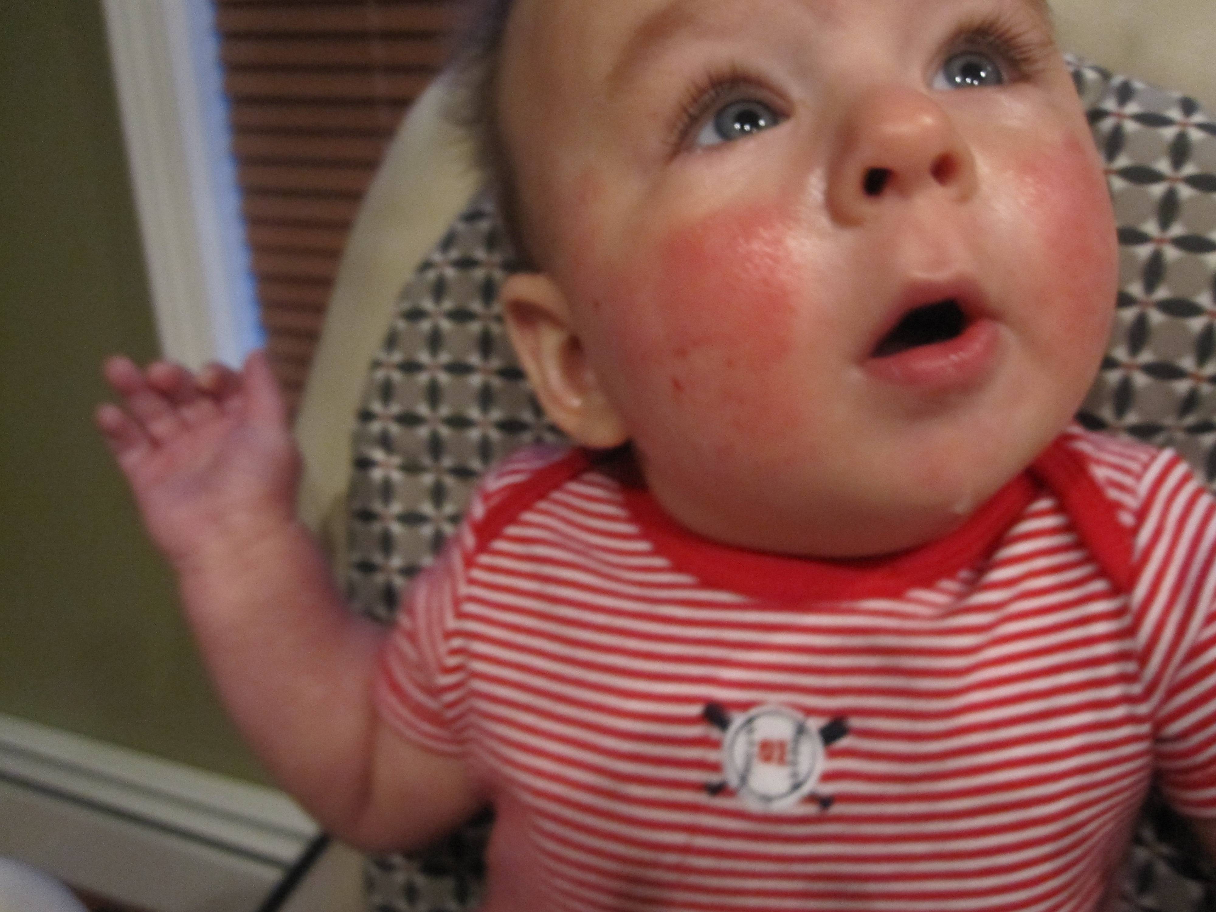 Почему младенцы красные. Аллергическая реакция у детей.