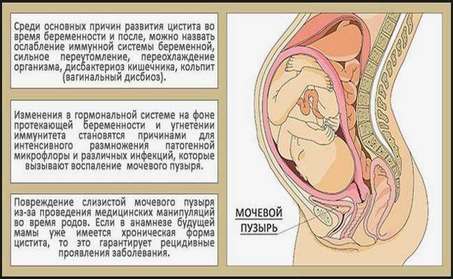 Головная боль на 2 триместре беременности