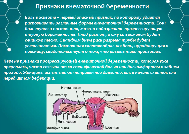 Как отличить внематочную. Критерии внематочной беременности. Внематочная беременность на ранних сроках. Беременность эктопическая – внематочная беременность.. Патогенез трубной внематочной беременности.