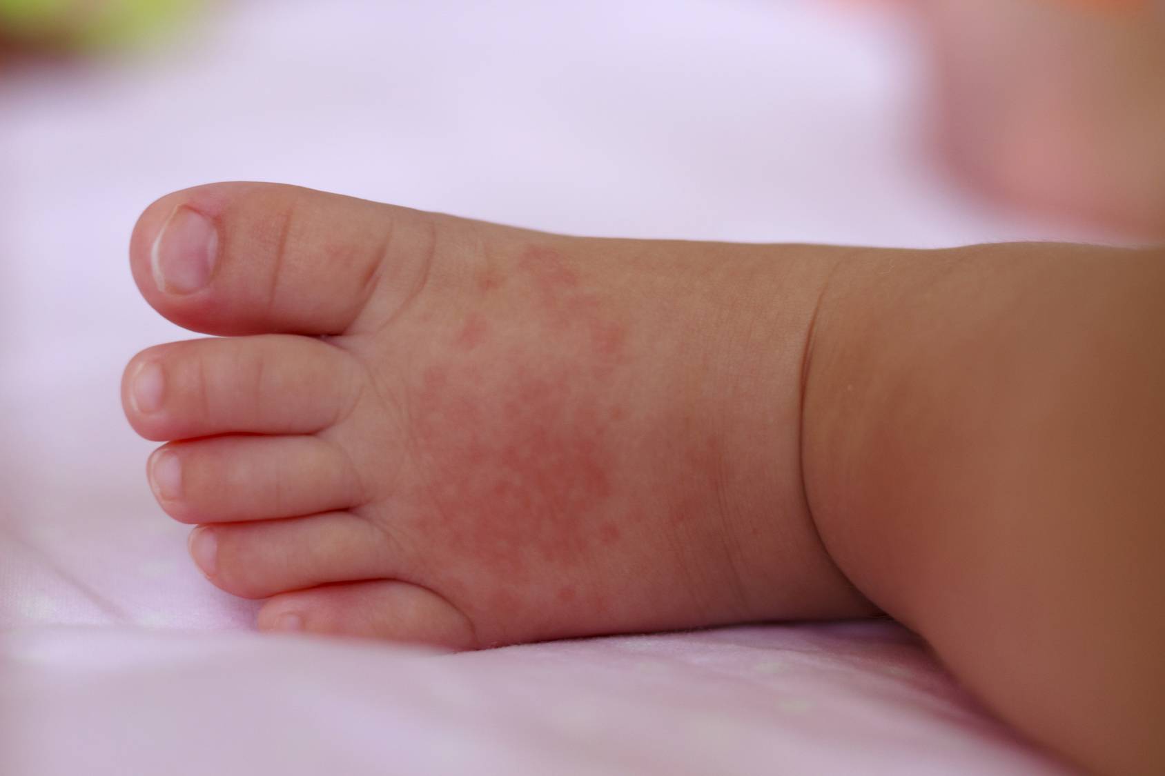 Аллергия у новорожденного - 95 фото самых явных признаков и проявлений пищевой аллергии